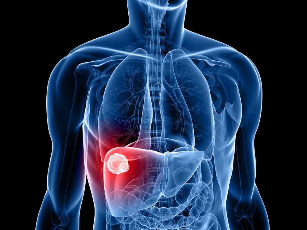 the-main-causes-and-symptoms-of-liver-cancer-activebeat