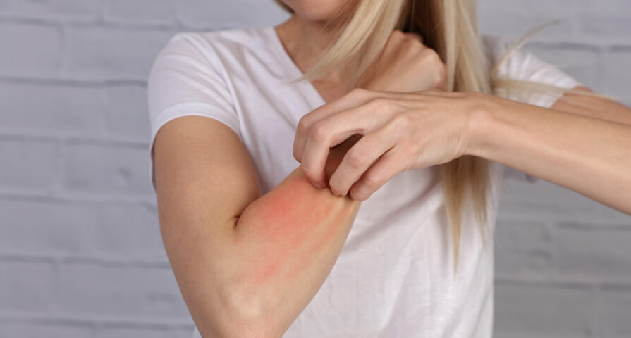What Causes Hives And How Dangerous Can They Be A Nurse Practitioner Explains Activebeat 0234