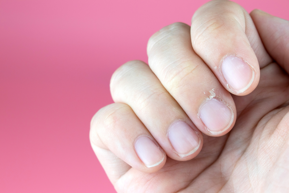 effective-home-remedies-for-hangnails-activebeat-your-daily-dose-of